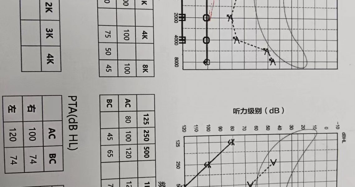 客户听力图